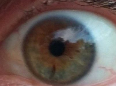 Глаз наркомана